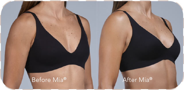 Mia Femtech before and after comparison showing natural breast harmonization results