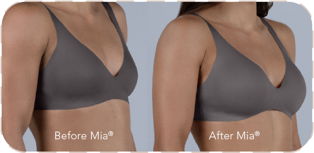 Mia Femtech before and after comparison showing natural breast harmonization results