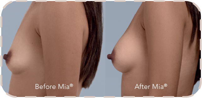 Mia Femtech before and after comparison showing natural breast harmonization results